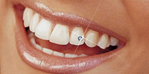 Bijoux dentaires Bourgoin-Jallieu